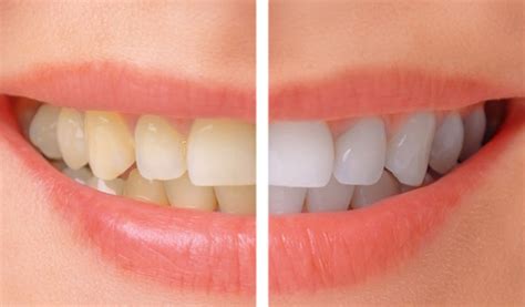 Cosmetic Dentistry in the Philippines: Its Services.